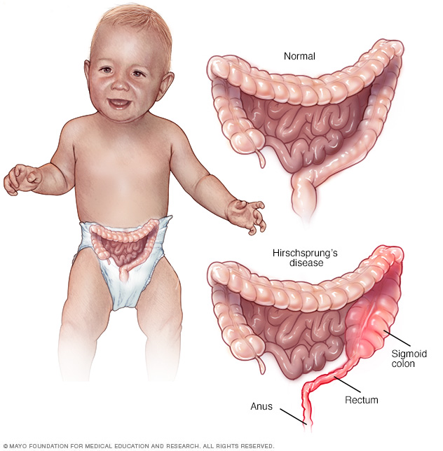 This condition is characterized by the presence of a congenital megacolon (source) 