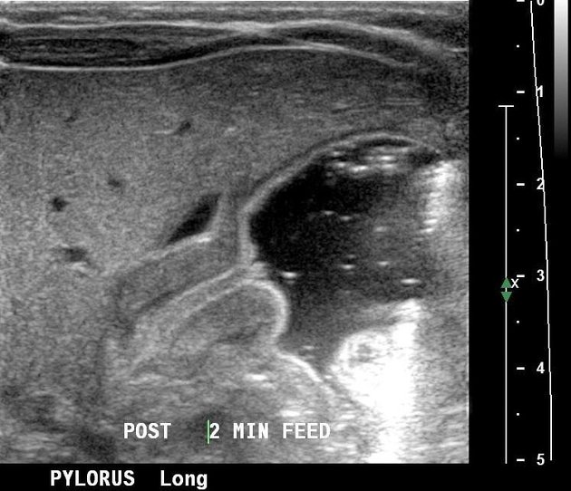 Abdominal ultrasound showing pyloric stenosis (source)