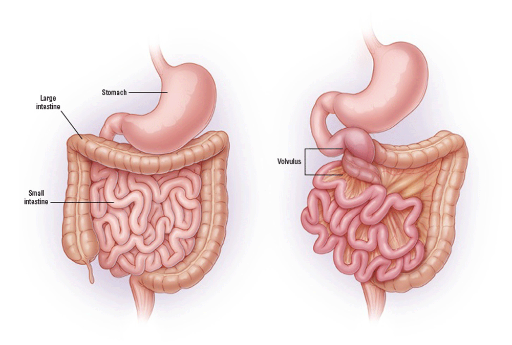 Congenital malrotation of the bowels may lead to volvulus/bowel obstruction (source)