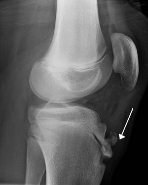 Fragmentation of the tibial tubercle seen on a lateral knee X-ray in a patient with Osgood-Schlatter disease (source) 