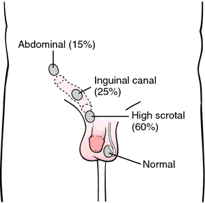 An undistended testicle my be found at different points along the path of the inguinal canal (source) 