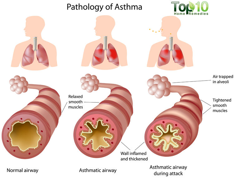 A central feature of asthma is the presence of inflammation in the airways (source) 