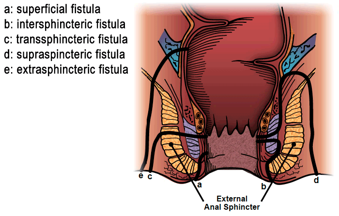 There are various categorizations of anal fistulas based upon their location (source) 