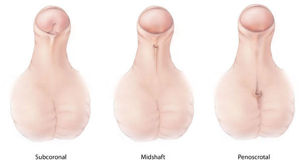 The exact location of the hypospadias can vary in patients (source)
