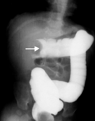 Barium enema showing intussusception of the large colon (arrow, source)