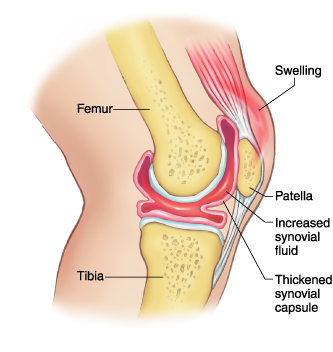Features of synovitis (source)