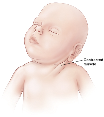 Example of torticollis in an infant (source). 