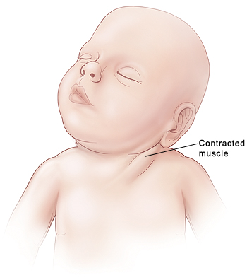Example of torticollis in an infant (source).