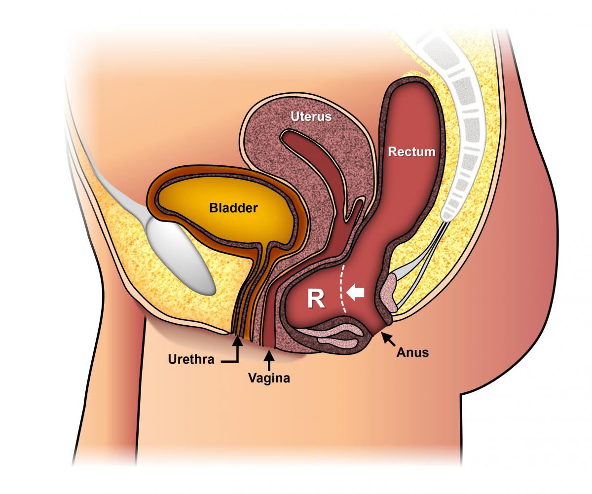 Rectocele Pictures