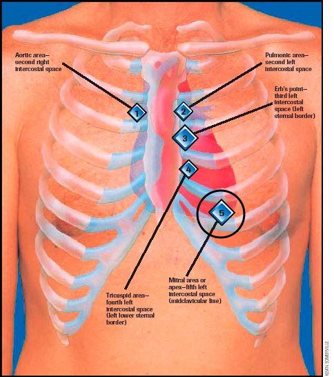 guide-to-heart-murmurs-mitral-regurgitation-murmur-stepwards
