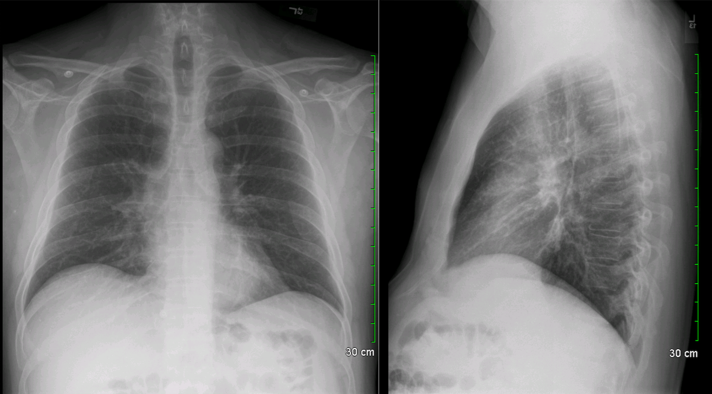 Archive Of Unremarkable Radiological Studies Chest X Ray Stepwards