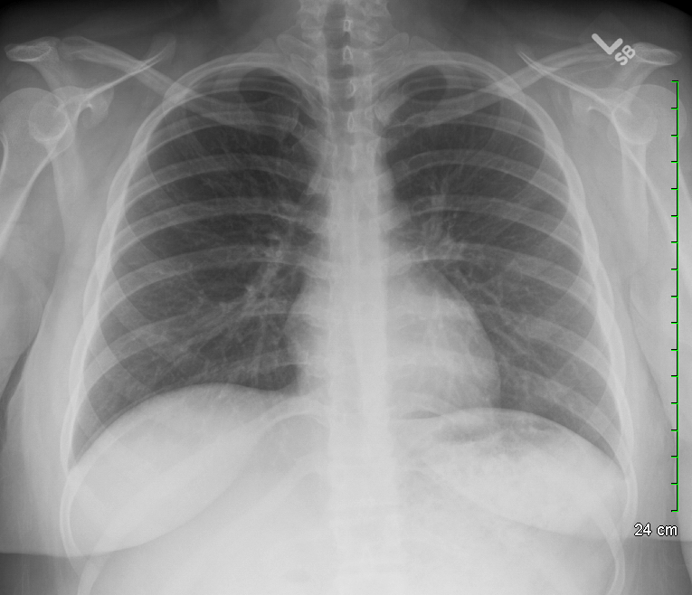 Archive Of Unremarkable Radiological Studies Chest X Ray Stepwards