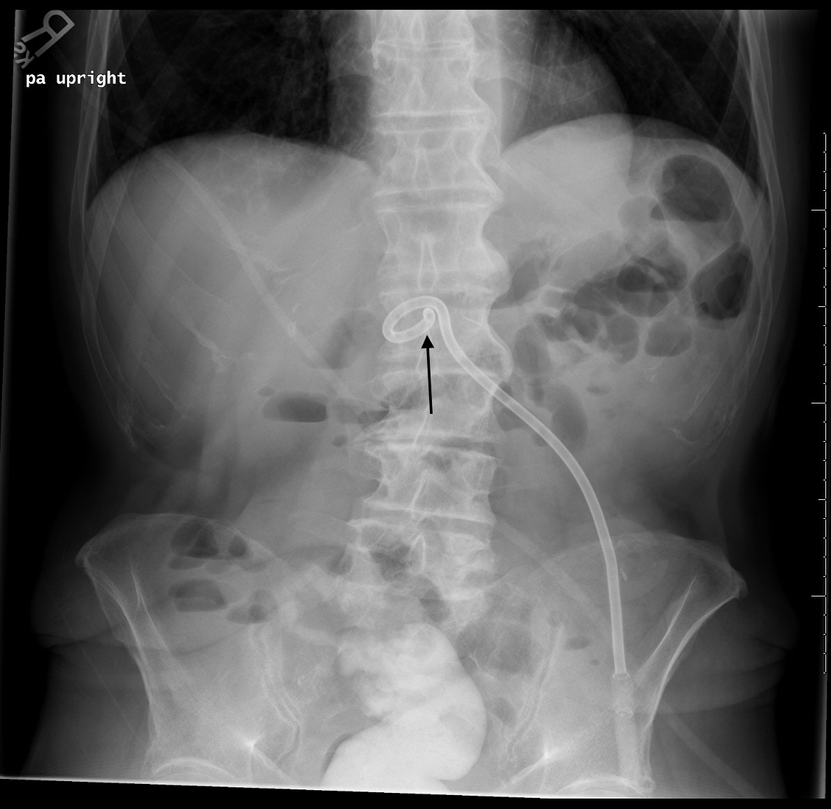 Condition Specific Radiology Gastronomy Tube (GTube) Stepwards