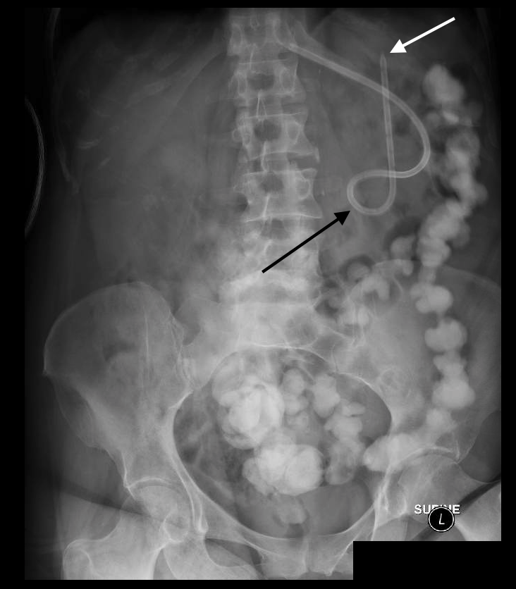 What Is Sticking Out Of My Patient? Characterizing Percutaneous Feeding
