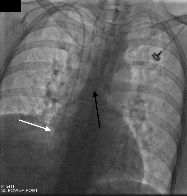 Interventional Radiology Procedures: Chest Port Placement - Stepwards