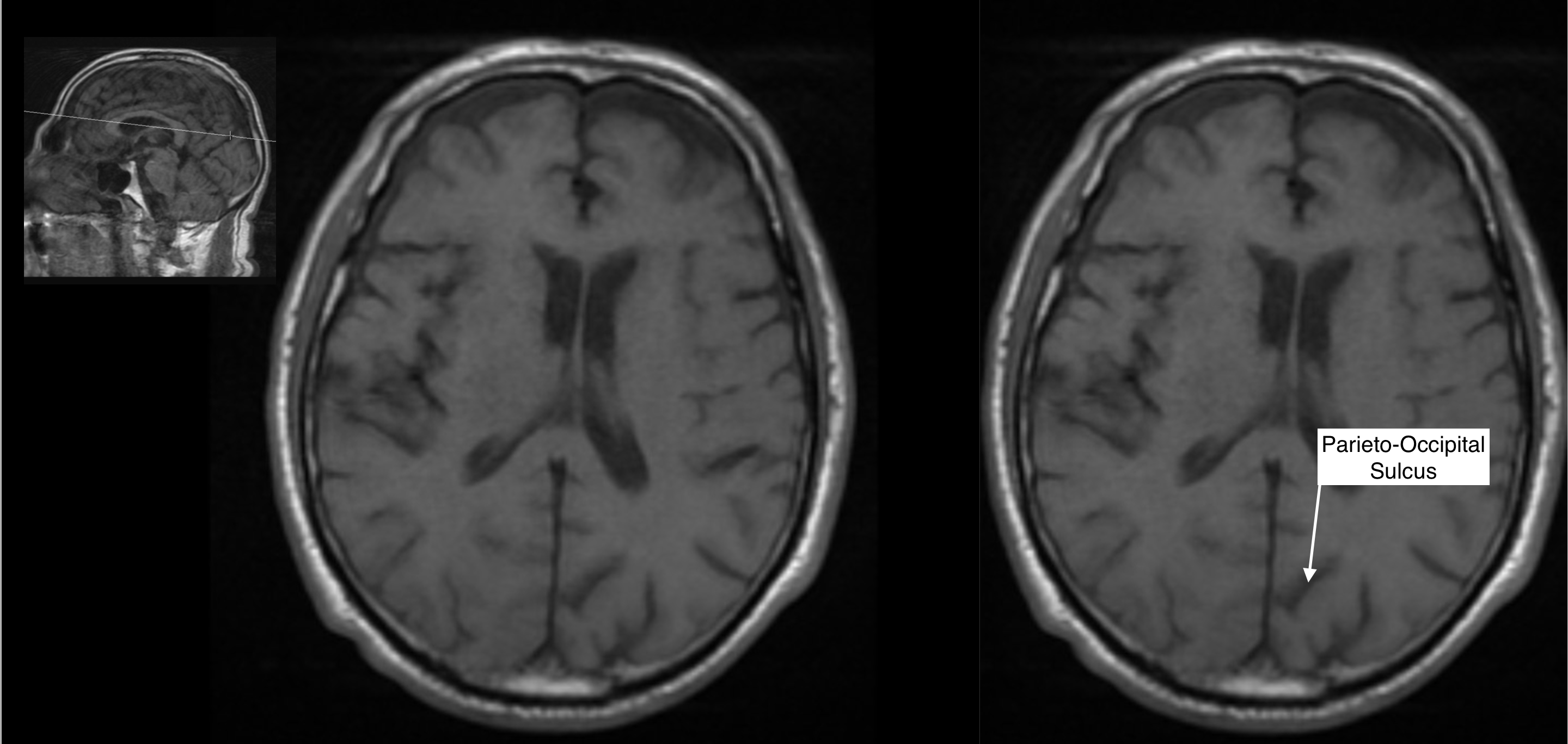 Radiological Anatomy: Parieto-Occipital Sulcus - Stepwards