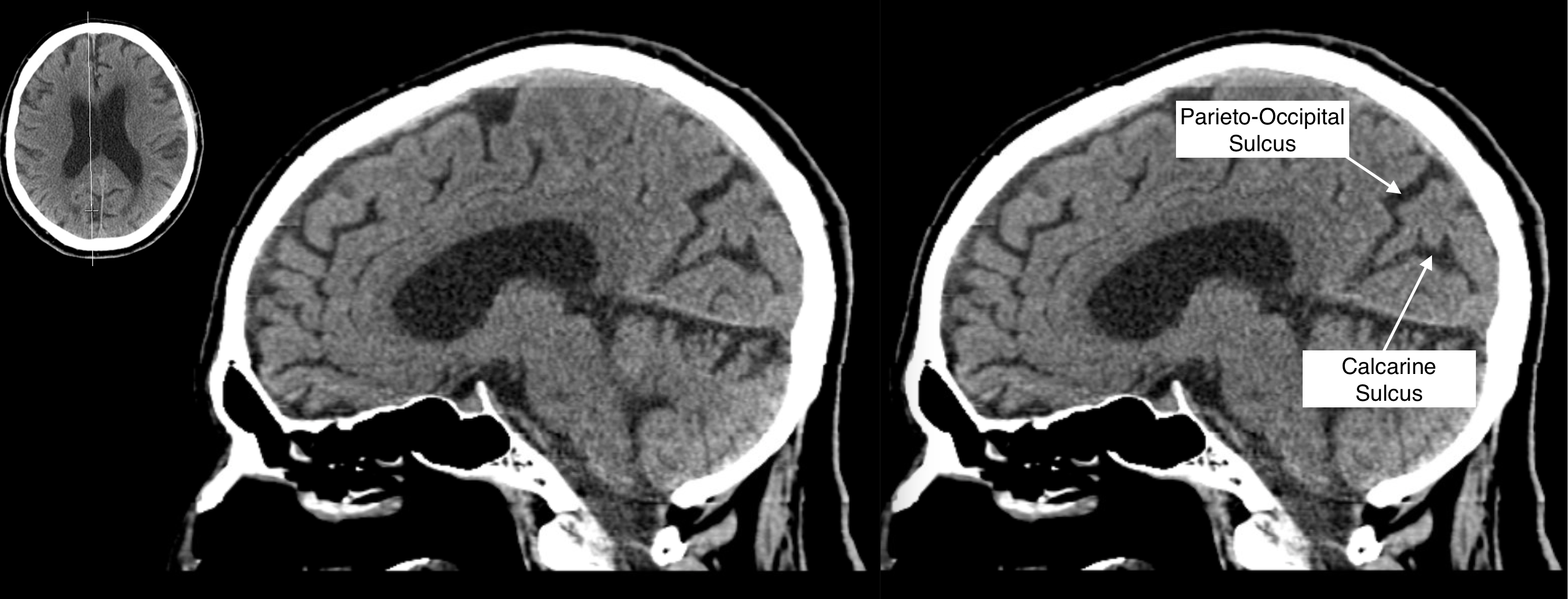 Radiological Anatomy: Calcarine Sulcus - Stepwards