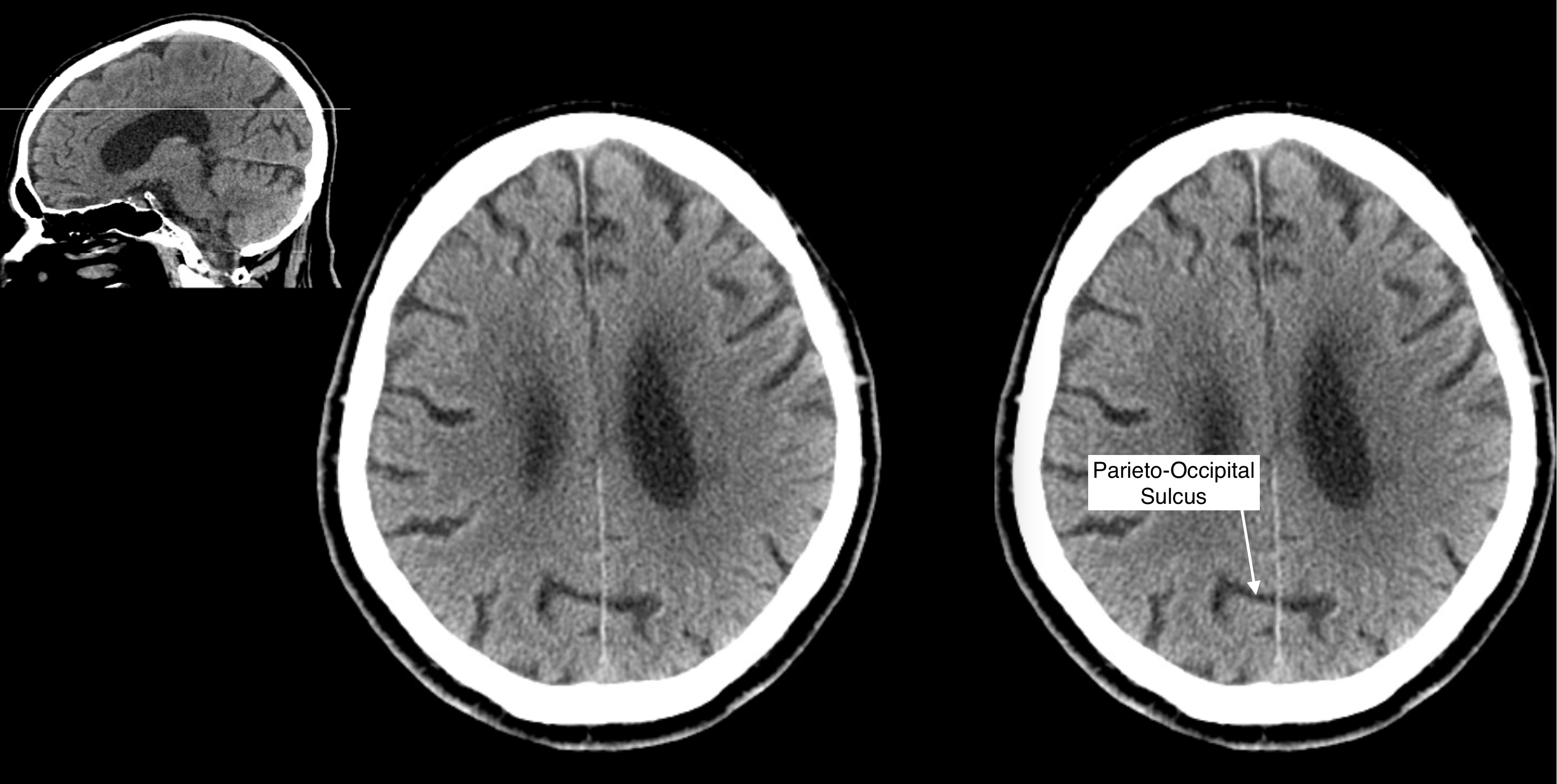Radiological Anatomy: Parieto-Occipital Sulcus - Stepwards