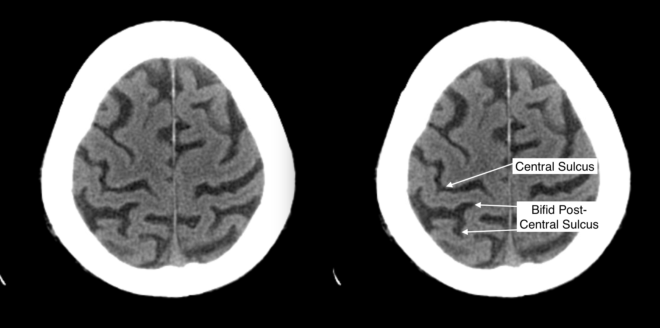 Radiological Anatomy: Central Sulcus - Stepwards