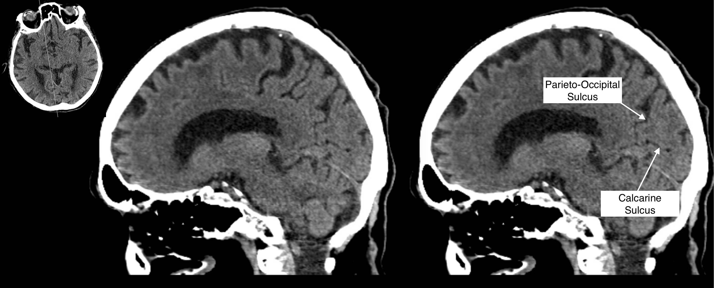 Radiological Anatomy: Calcarine Sulcus - Stepwards