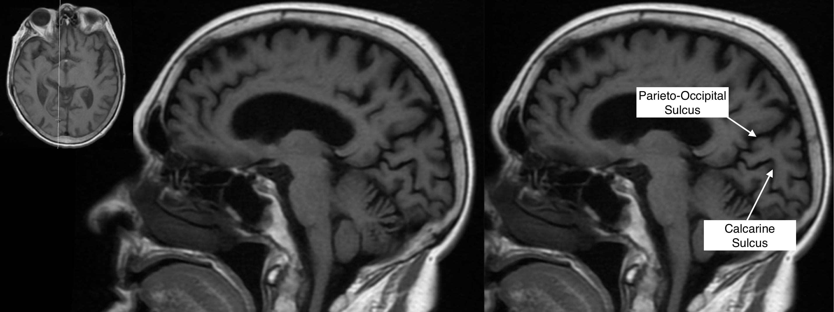 Radiological Anatomy: Calcarine Sulcus - Stepwards