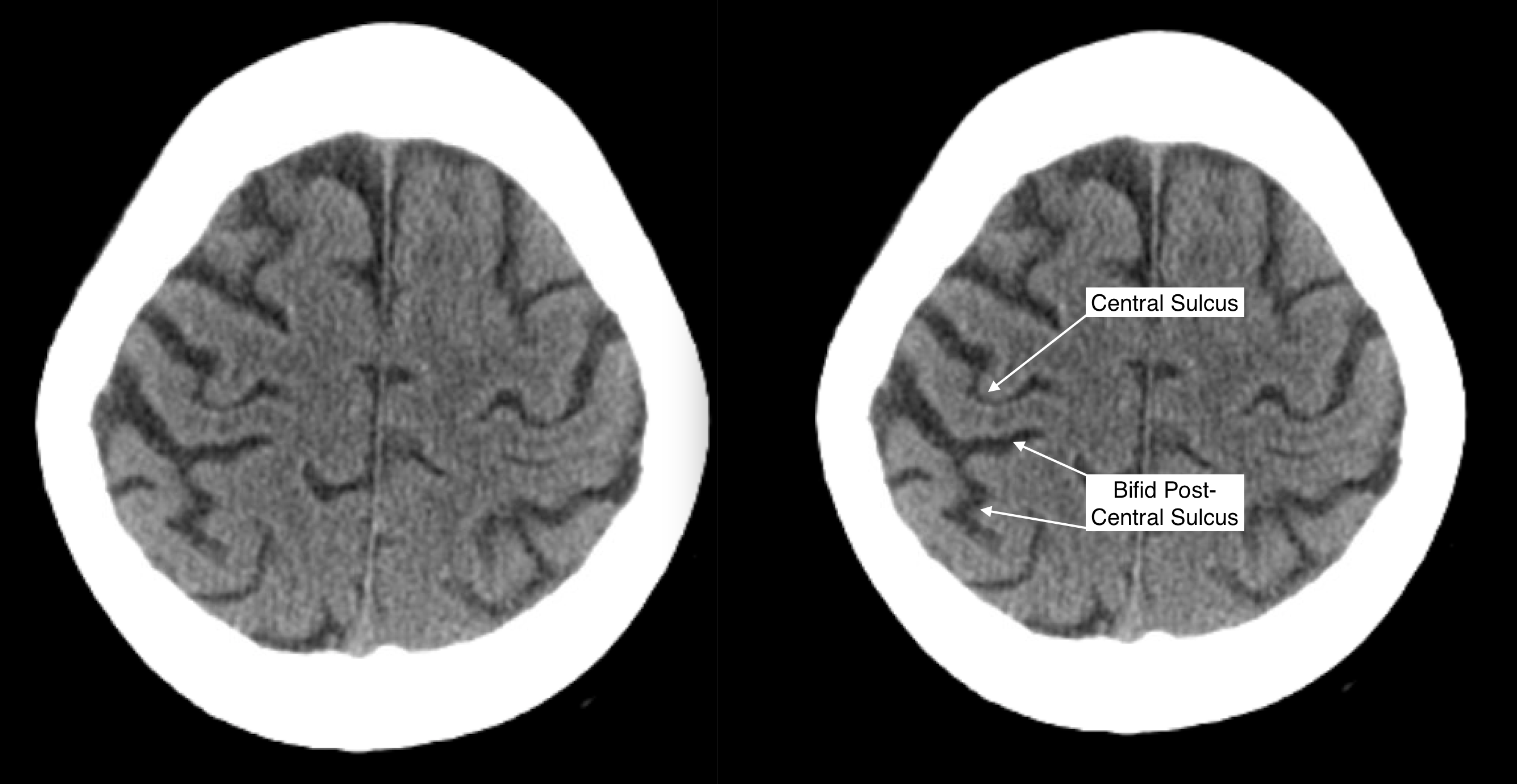 Radiological Anatomy Central Sulcus Stepwards