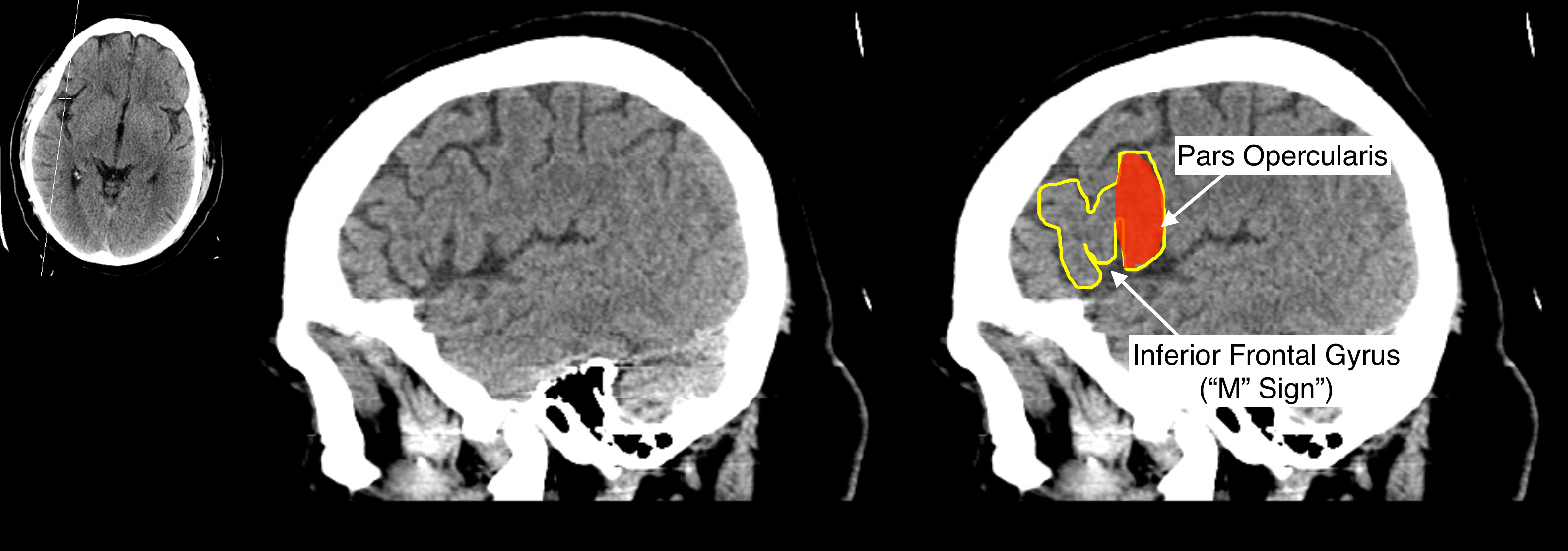 Radiological Anatomy: Pars Opercularis - Stepwards
