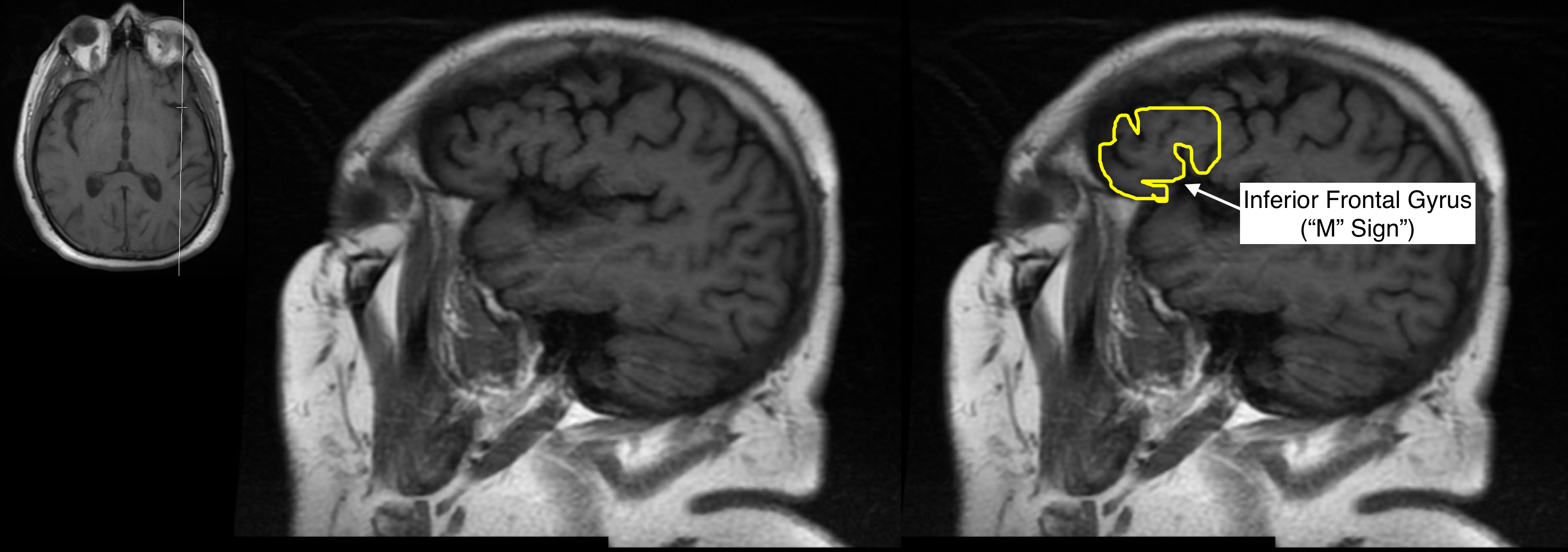 Radiological Anatomy Inferior Frontal Gyrus Stepwards