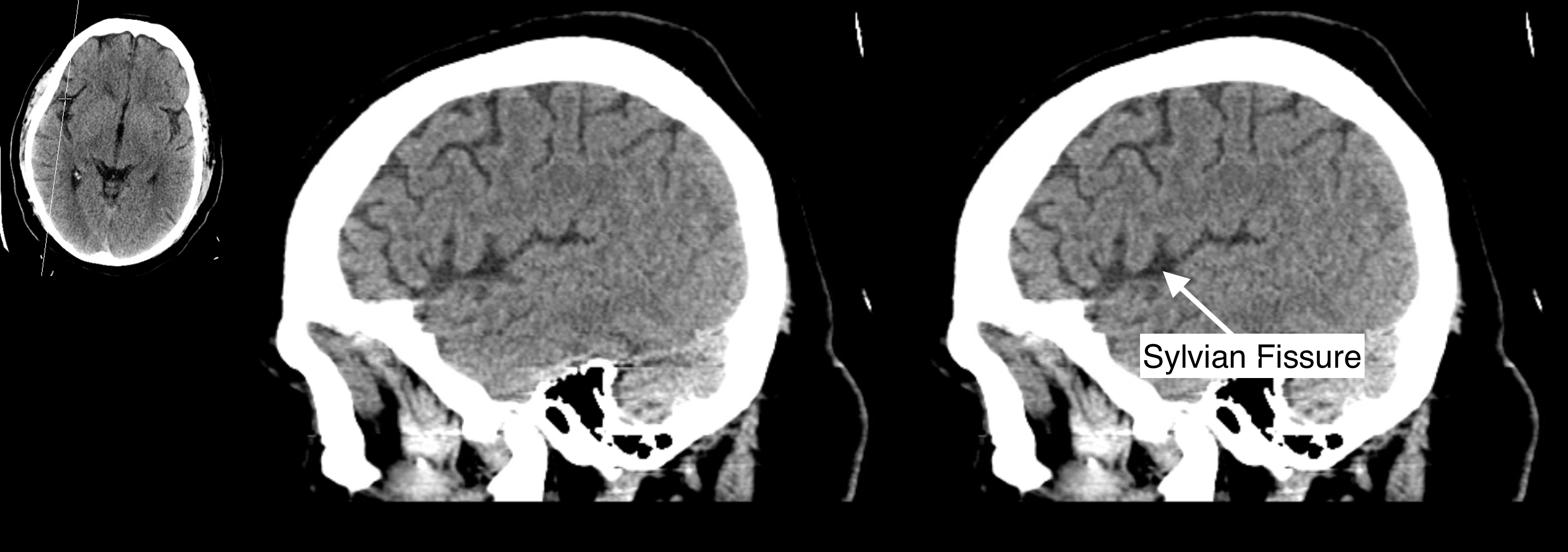 Radiological Anatomy: Sylvian Fissure - Stepwards