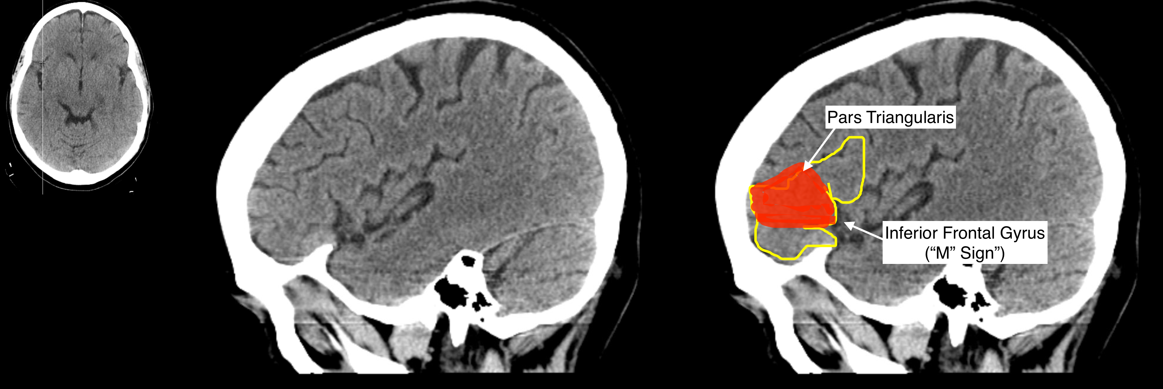 Radiological Anatomy: Pars Triangularis - Stepwards