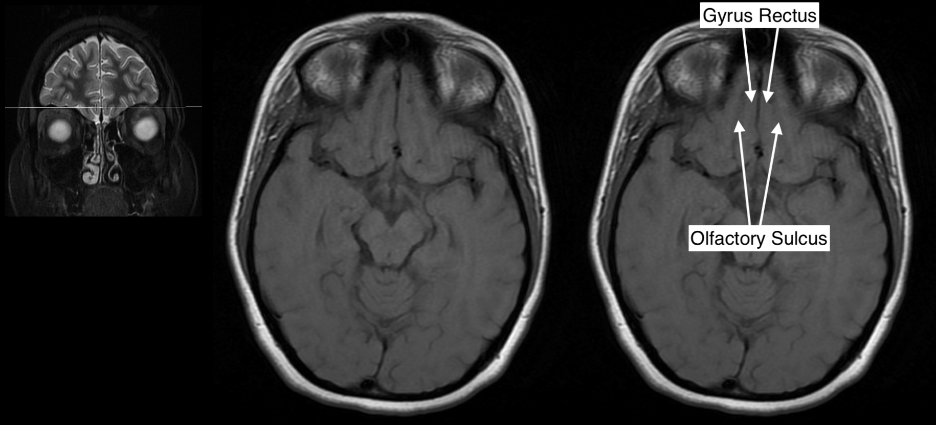 Radiological Anatomy Gyrus Rectus Stepwards