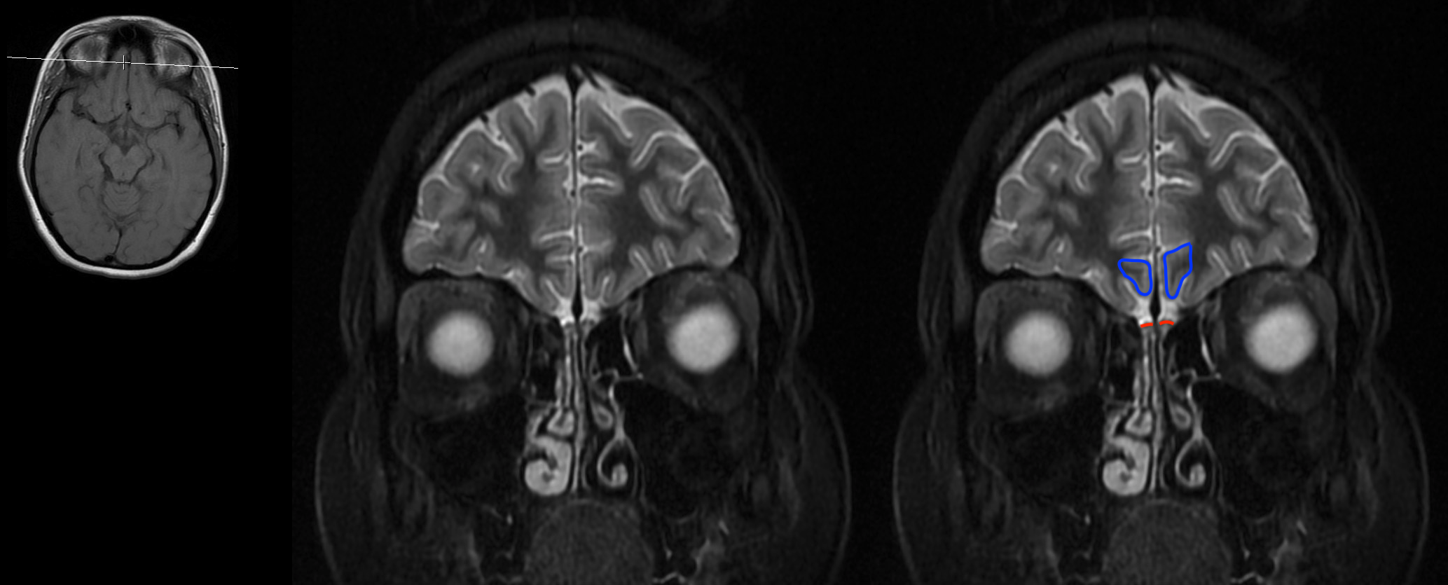 Radiological Anatomy: Gyrus Rectus - Stepwards