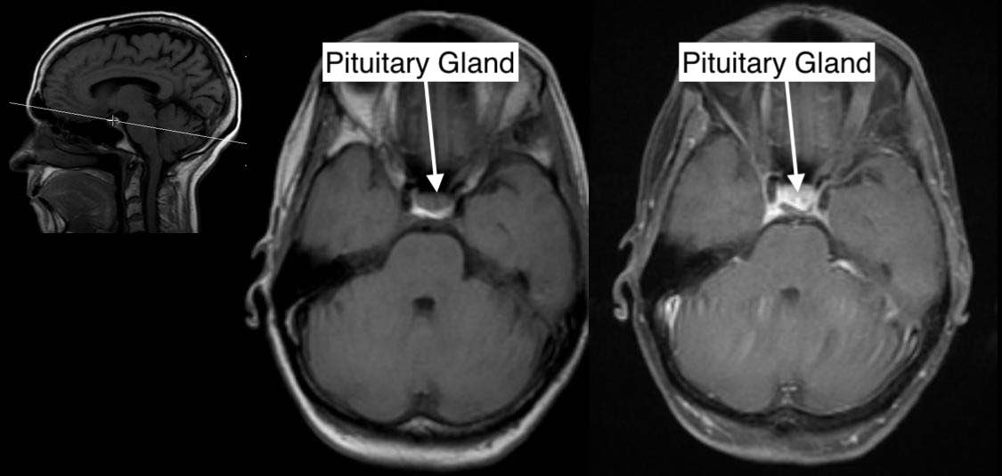 Radiological Anatomy: Pituitary Gland - Stepwards