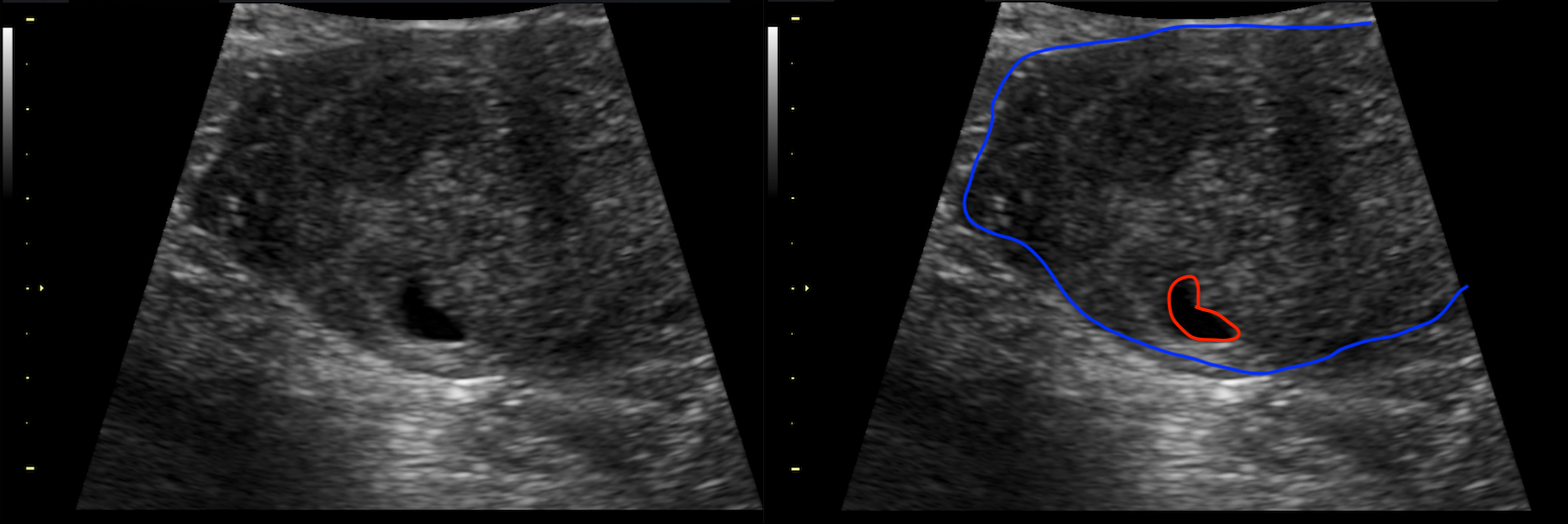 Condition Specific Radiology Heterotopic Pregnancy Stepwards