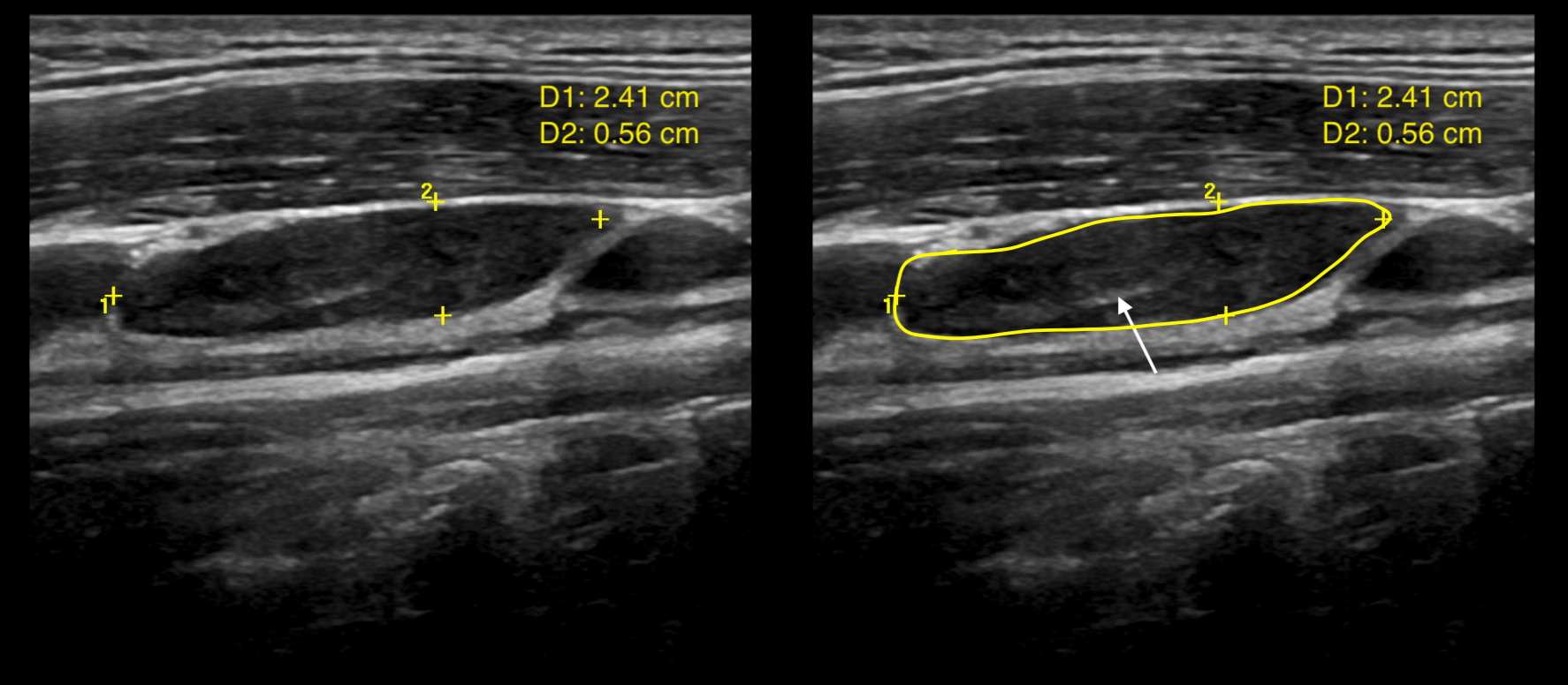 Condition Specific Radiology Hashimoto Thyroiditis Stepwards