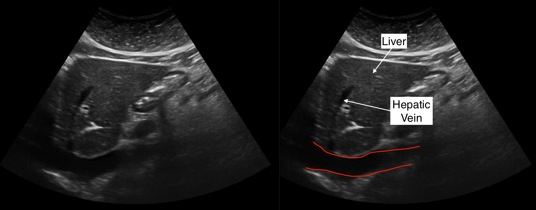 Protocoling Imaging Studies Complete Abdominal Ultrasound Ultrasound