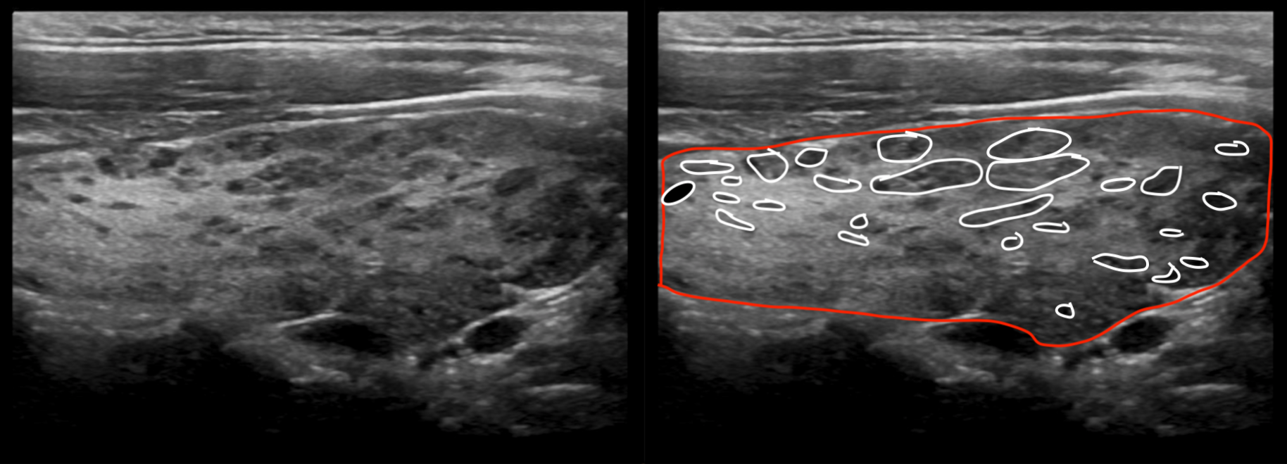 Condition Specific Radiology: Hashimoto Thyroiditis - Stepwards