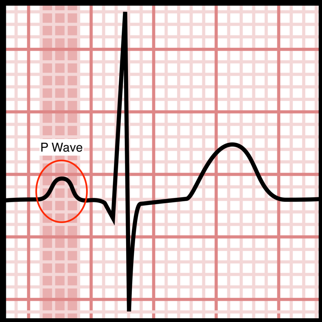 Electrocardiograms (EKGs/ECGs): Evaluating P Waves - Stepwards