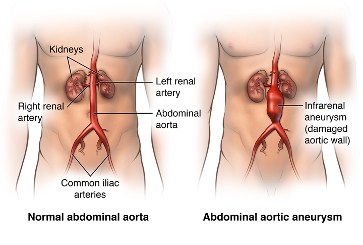 Abdominal Aortic Aneurysm AAA Stepwards