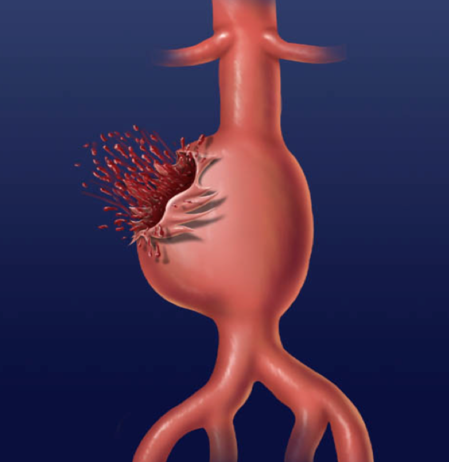 Abdominal Aortic Aneurysm AAA Stepwards