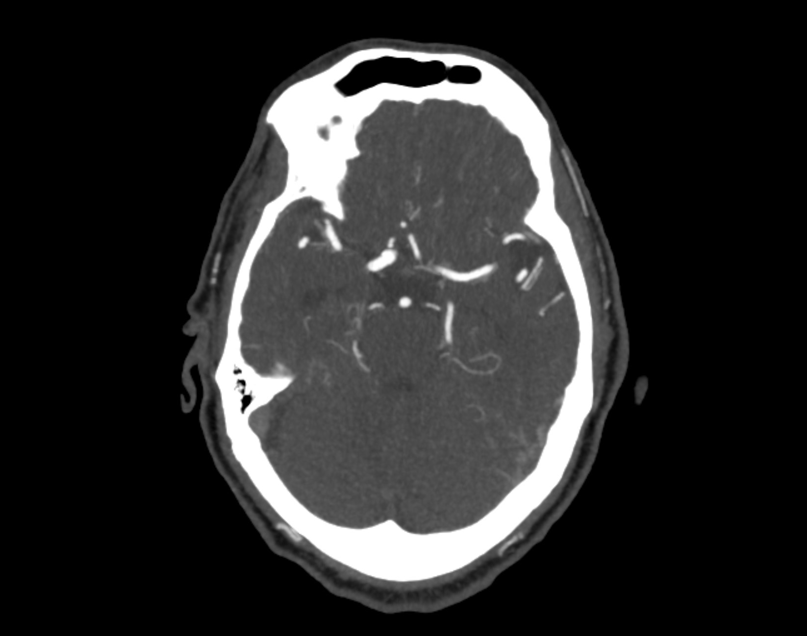 ct cta head and neck cpt code