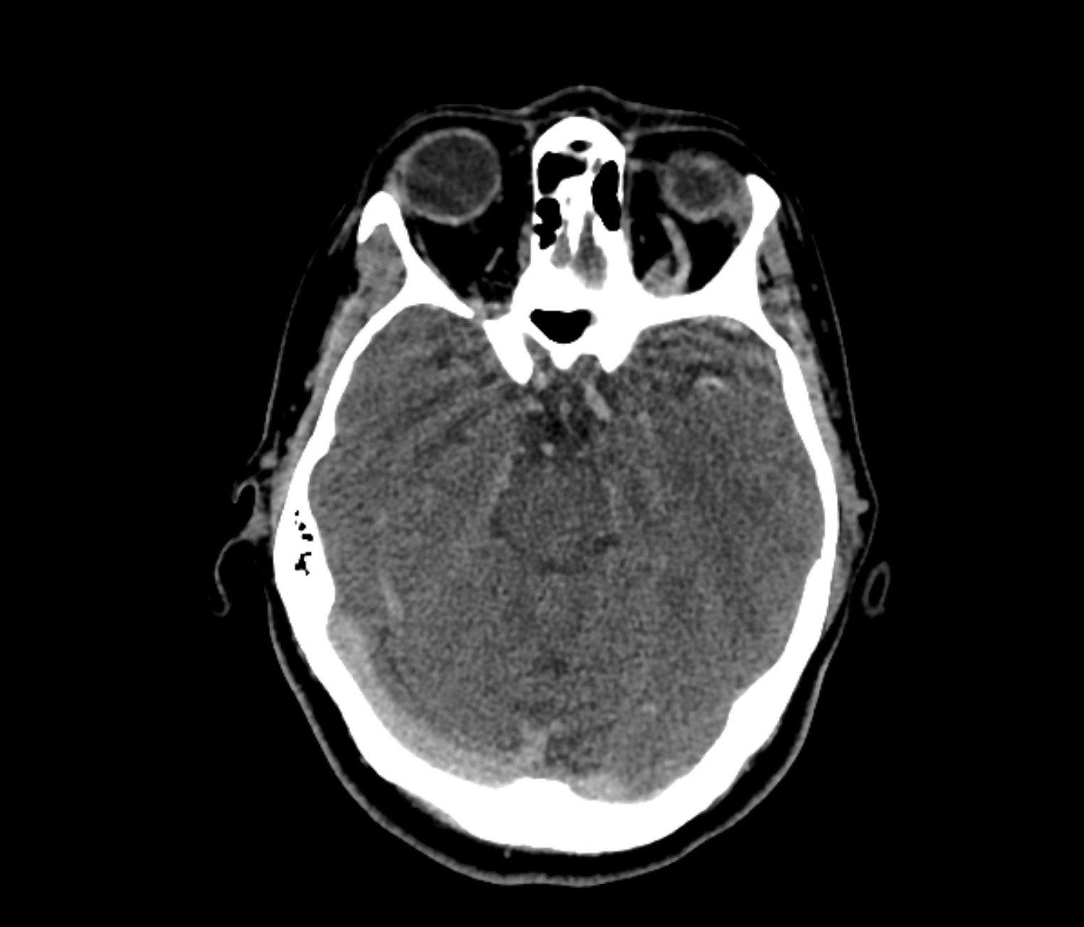 ct venogram head and neck protocol