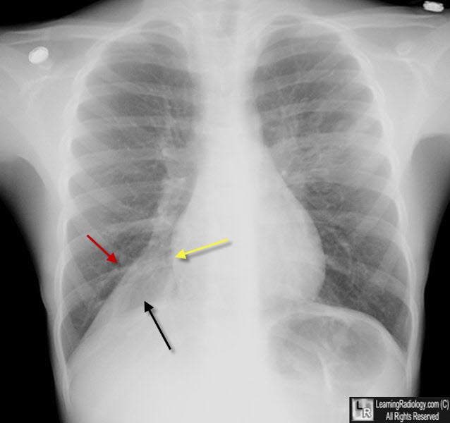 Condition Specific Radiology Atelectasis Stepwards