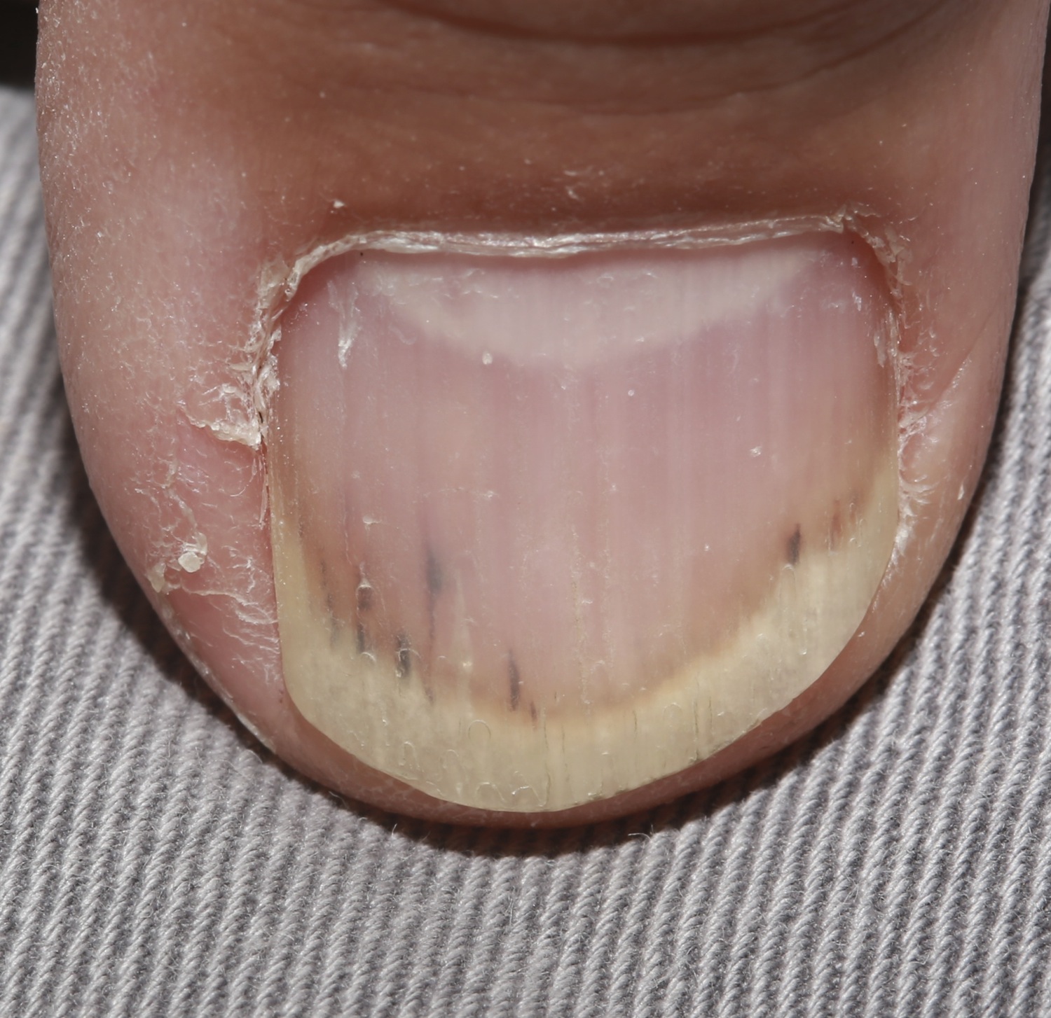 Infective Endocarditis - Dr Qaisar Ahmed MD, DHMS