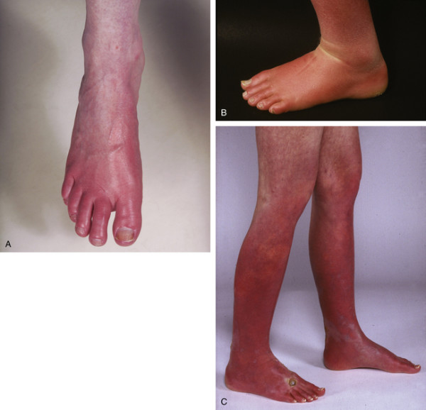 Polycythemia Vera Stepwards