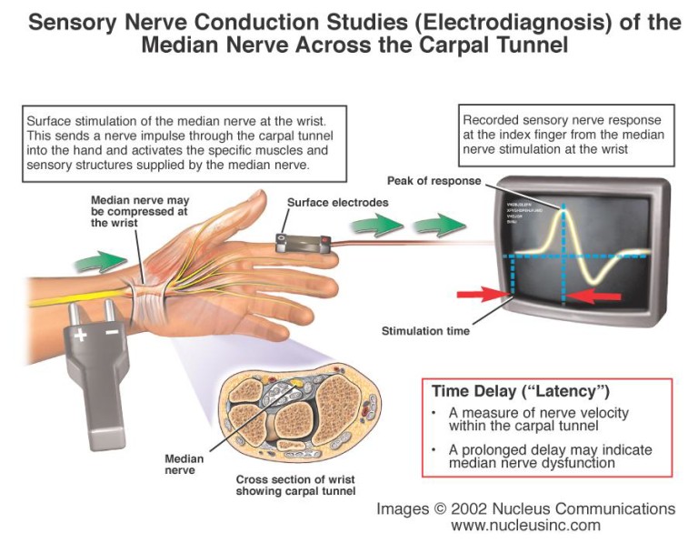 Carpal Tunnel Syndrome Stepwards