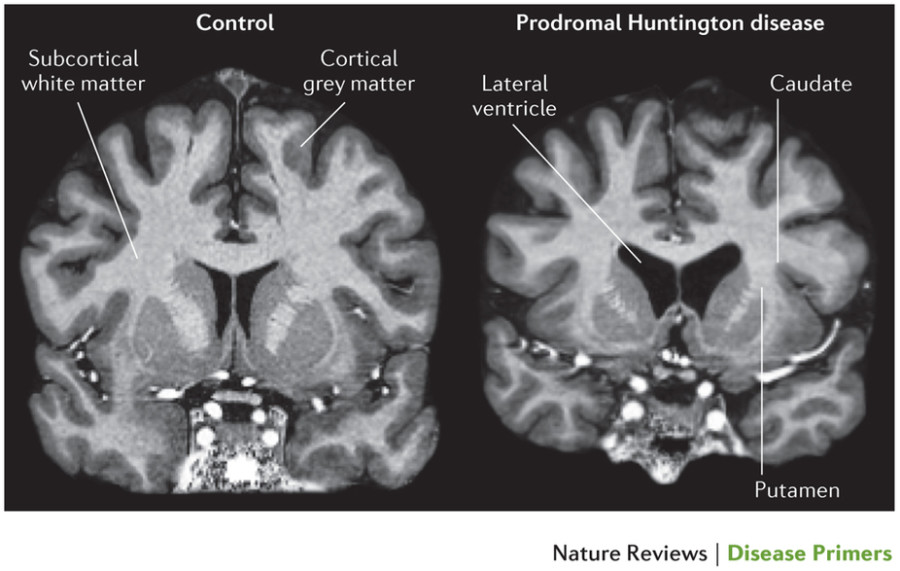 Huntington Disease (HD) Stepwards