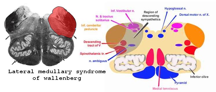 Wallenberg Syndrome Lateral Medullary Syndrome Of Wallenberg RisMed 