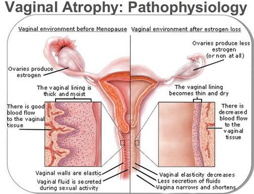 Atrophic Vaginitis