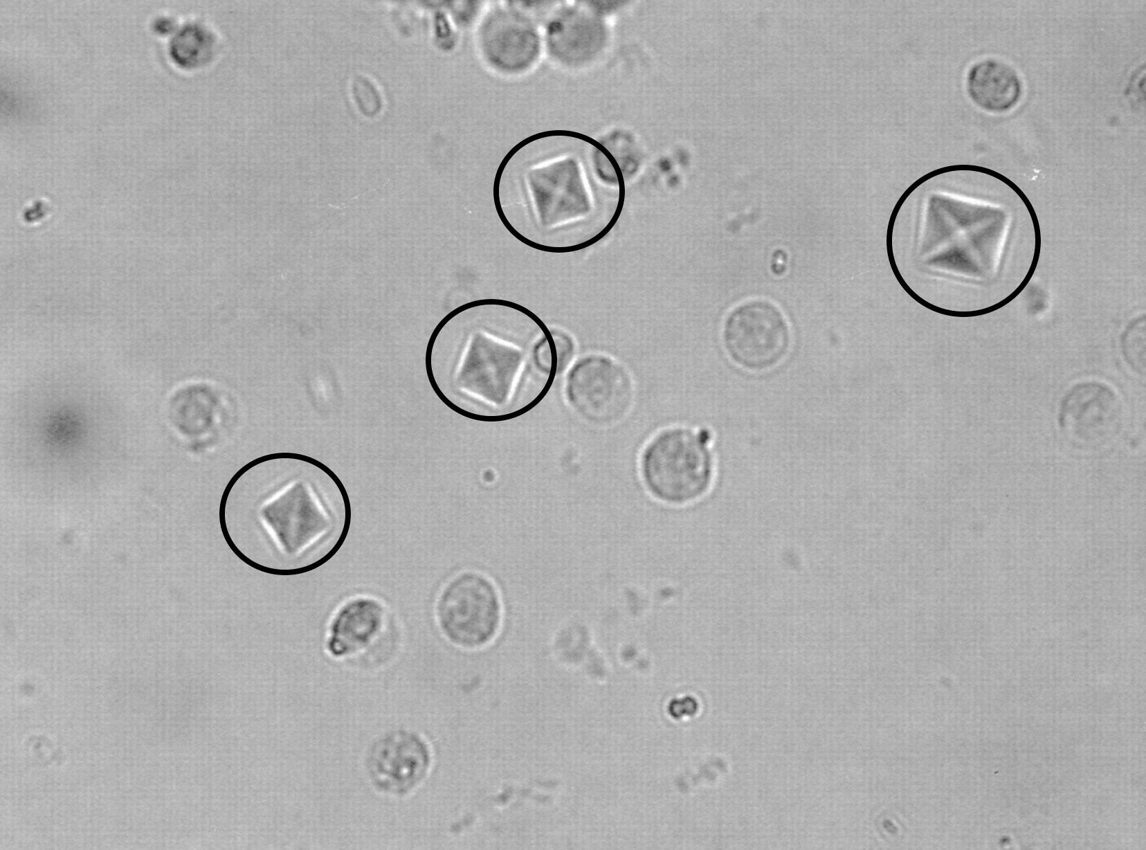 Эритроциты в простате. Оксалаты кальция в моче микроскопия. Кристаллы оксалата кальция микроскопия. Струвиты микроскопия. Оксалаты в моче микроскопия.